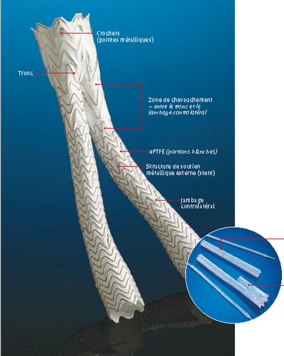Endoprothèse Aorte abdominale
