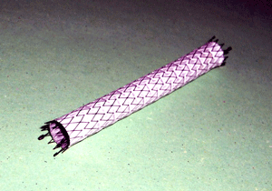 Un stent couvert de 8 mm utilisé pour les lésions iliaques. Un stent couvert de 8 mm utilisé pour les lésions iliaques.
