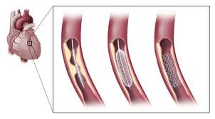 ANGIOPLASTIE ANGIOPLASTIE