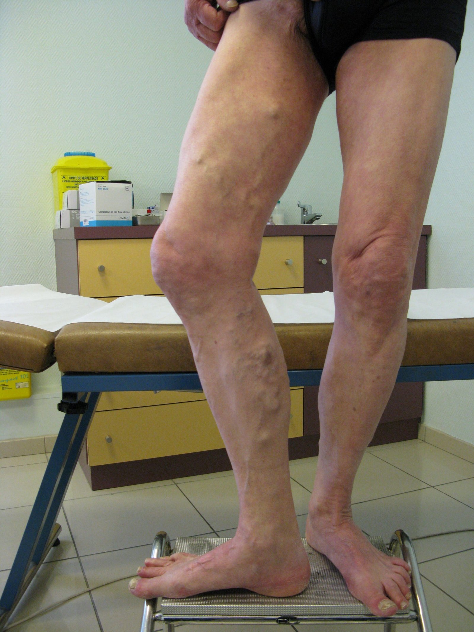 préopératoire Varicose Vein treatment phlebectomy Ablation le même patient