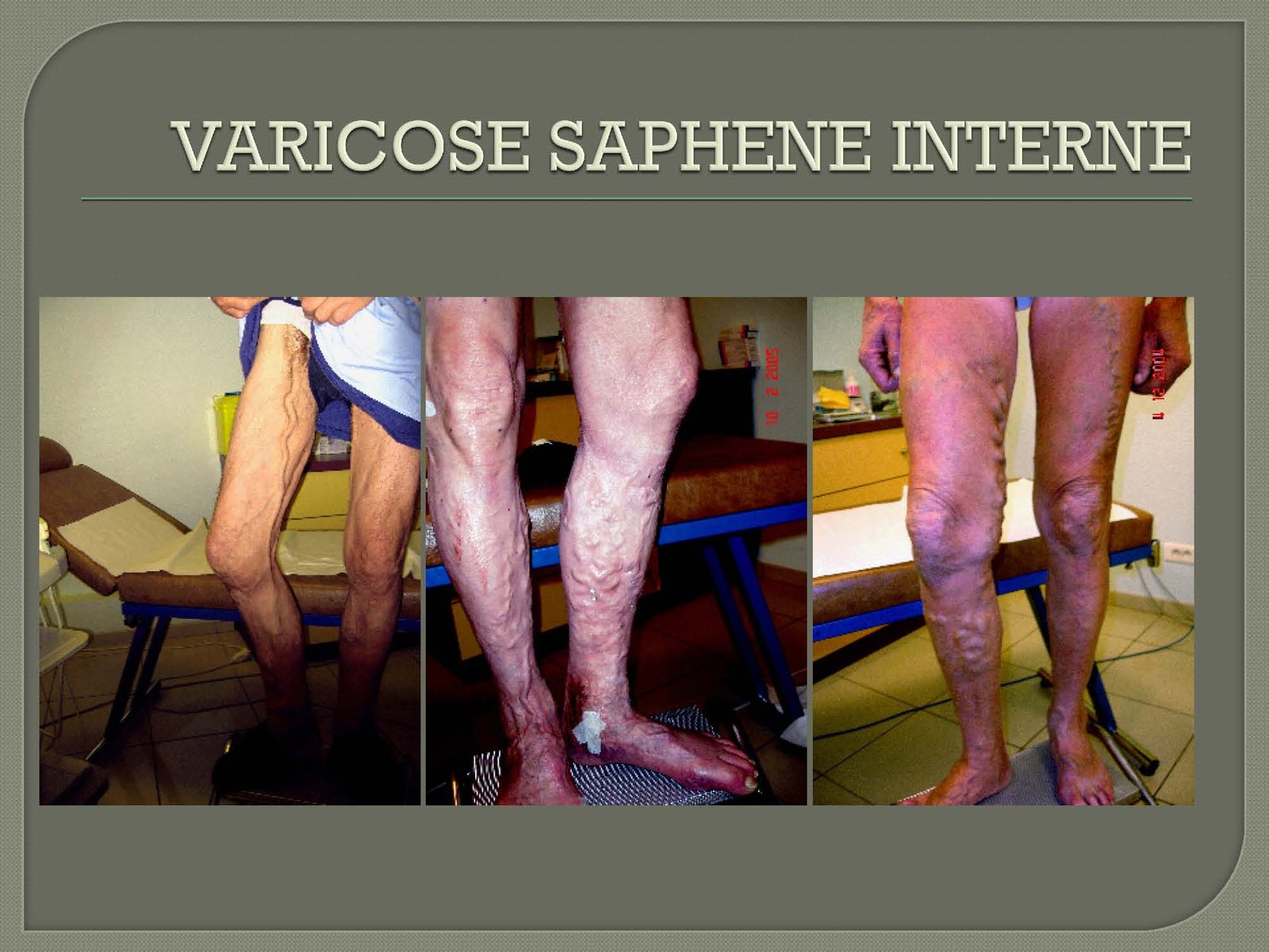Varicose Vein treatment EVLT and phlebectomy Ablation Varicose Vein treatment EVLT and phlebectomy Ablation