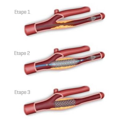 Angioplastie stent carotidien interne par Edmond Le Borgne Angioplastie stent carotidien