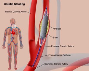 angioplastie stenting carotidien par Edmond Le Borgne angioplastie stenting carotidien