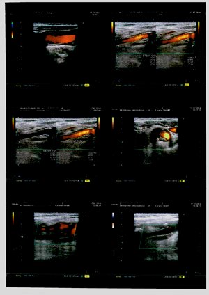 Triple stenting carotidien par Edmond Le Borgne triple stenting carotidien