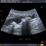 stenose aortique