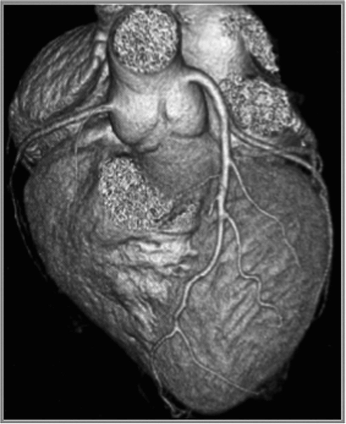 Le « coroscanner » (ou scanner cardiaque) est un examen d'imagerie médicale utilisant des rayons X pour visualiser le cœur et ses artères coronaires. Il permet de détecter des obstructions partielles ou complètes, des plaques d'athérome et d'évaluer le risque cardiovasculaire. L'examen implique une injection intraveineuse de produit de contraste iodé et une synchronisation avec l'électrocardiogramme pour obtenir des images nettes.