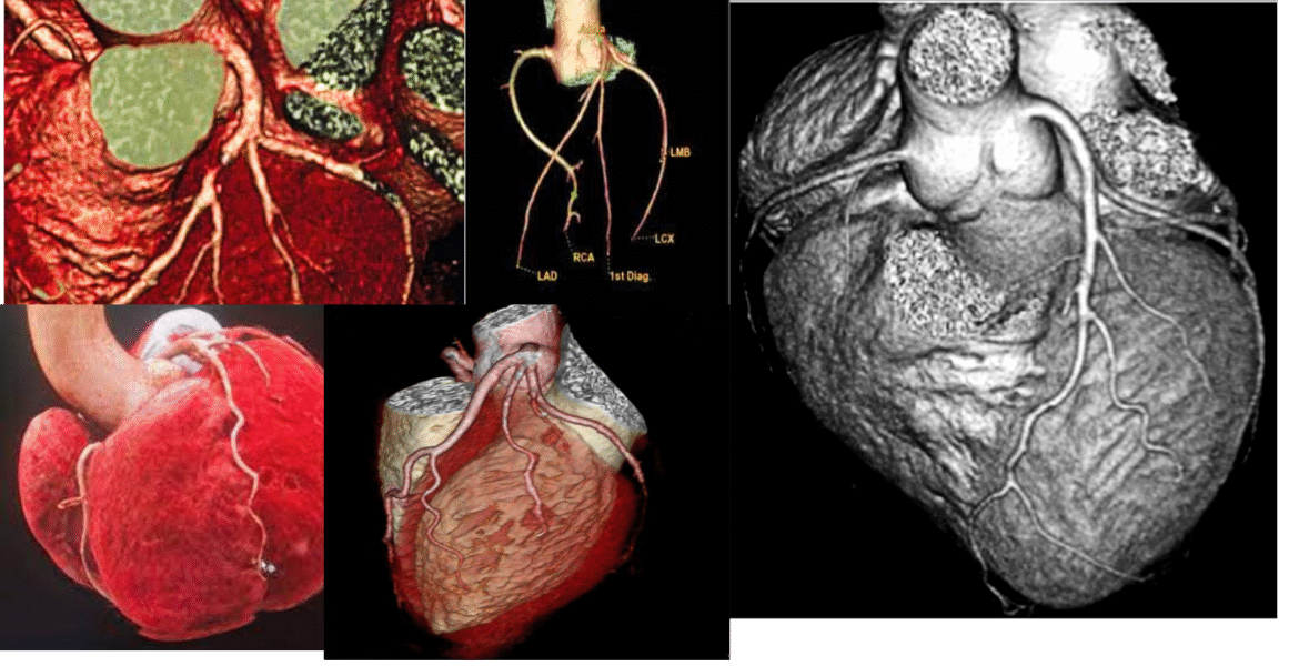 Le « coroscanner » (ou scanner cardiaque) est un examen d'imagerie médicale utilisant des rayons X pour visualiser le cœur et ses artères coronaires. Il permet de détecter des obstructions partielles ou complètes, des plaques d'athérome et d'évaluer le risque cardiovasculaire. L'examen implique une injection intraveineuse de produit de contraste iodé et une synchronisation avec l'électrocardiogramme pour obtenir des images nettes.