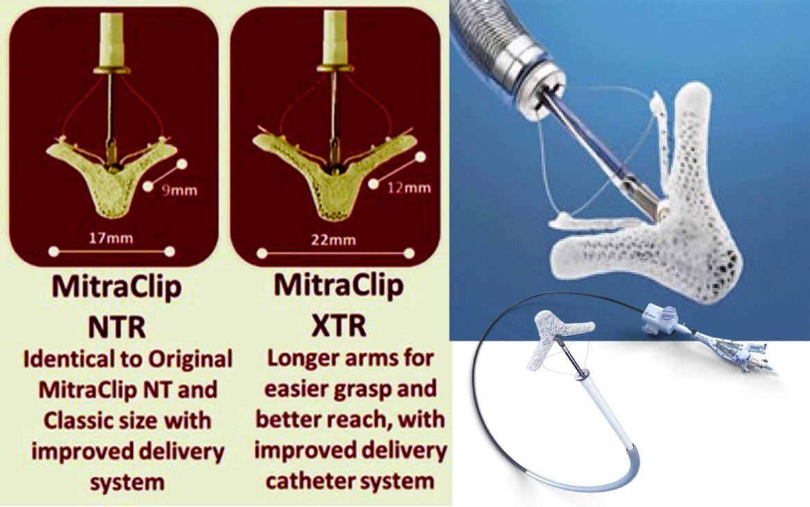La réparation mitrale percutanée par MitraClip est un traitement proposé depuis quelques années pour corriger les insuffisances mitrales (IM) secondaires de grade 3+/4+ des patients symptomatiques malgré une prise en charge médicale optimale. Son bénéfice clinique a été montré dans l’étude randomisée américaine COAPT (Cardiovascular Outcomes Assessment of the MitraClip Percutaneous Therapy for Heart Failure Patients with Functional Mitral Regurgitation)1 en montrant une baisse significative des hospitalisations pour insuffisance cardiaque et de la mortalité toutes causes, comparé au traitement médical seul (p